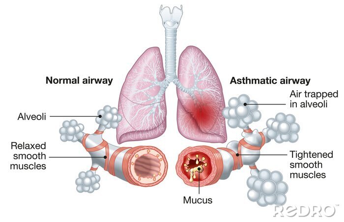 Bild Gesunde und kranke Atemwege